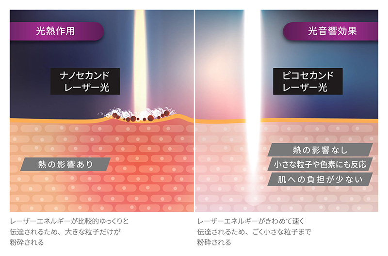 シミに有効な治療法 レーザー治療
