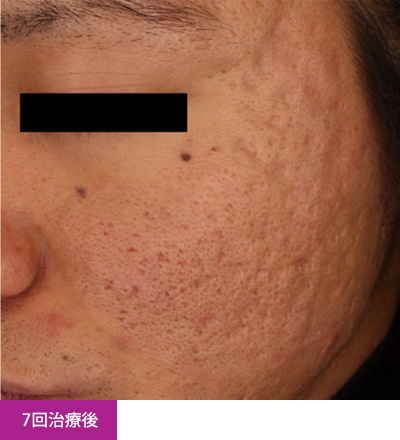 美容皮膚科 フラクショナルレーザー 平岡皮膚科スキンケアクリニック 札幌市清田区