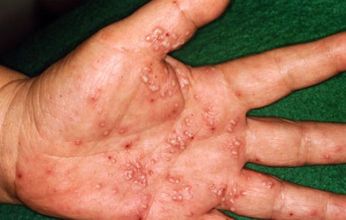 水ぶくれから膿疱に変異する、掌蹠膿疱症の様子。 